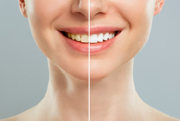 Teeth Whitening
