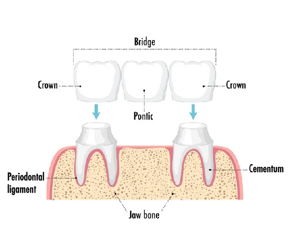 Crown and Bridges