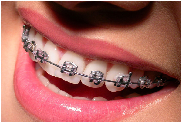Ortho Braces Treatment